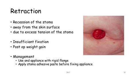 stmmi|stoma medical term.